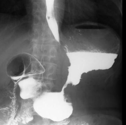 Wat laat de röntgenfoto van de maag en de slokdarm zien?